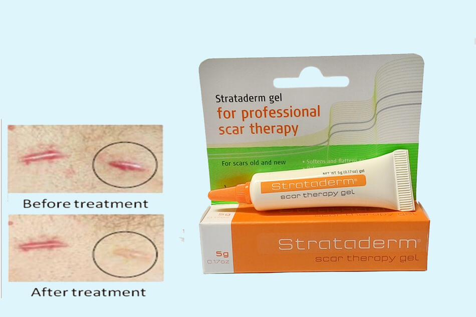 Kem trị sẹo Strataderm Scar Therapy Gel 5g có giá 400.000đ