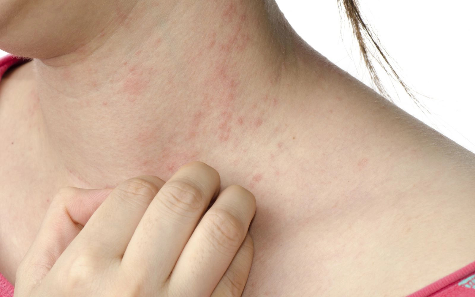 Kem trị sẹo Contractubex có thể gây ra các tác dụng phụ như dị ứng, viêm da